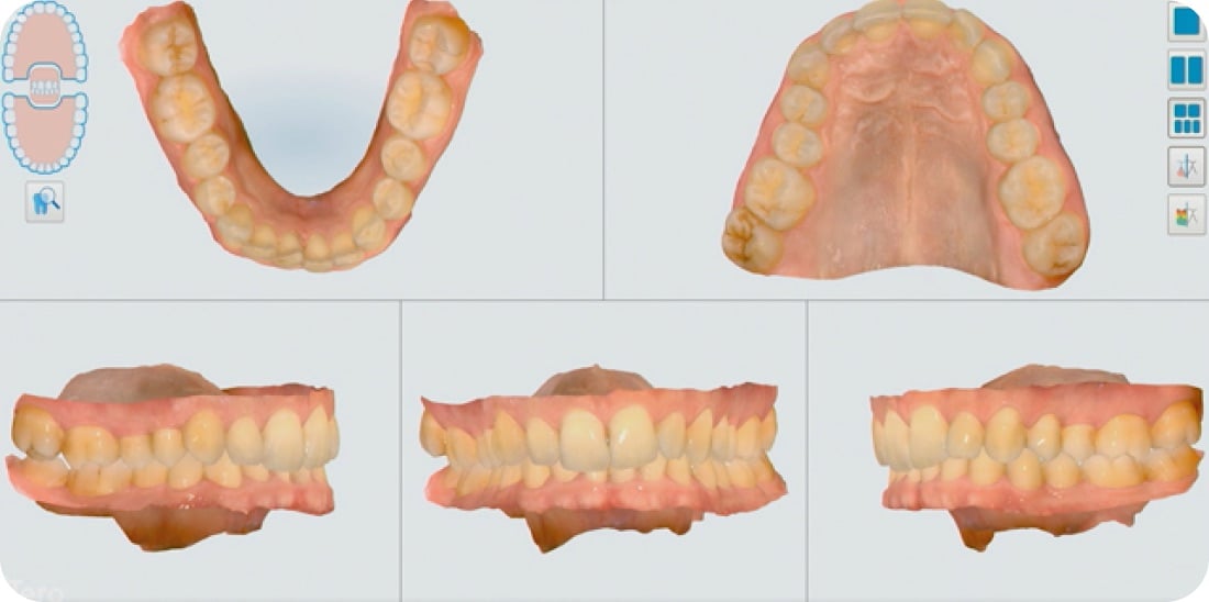iTero Lumina digital scans of teeth and bite