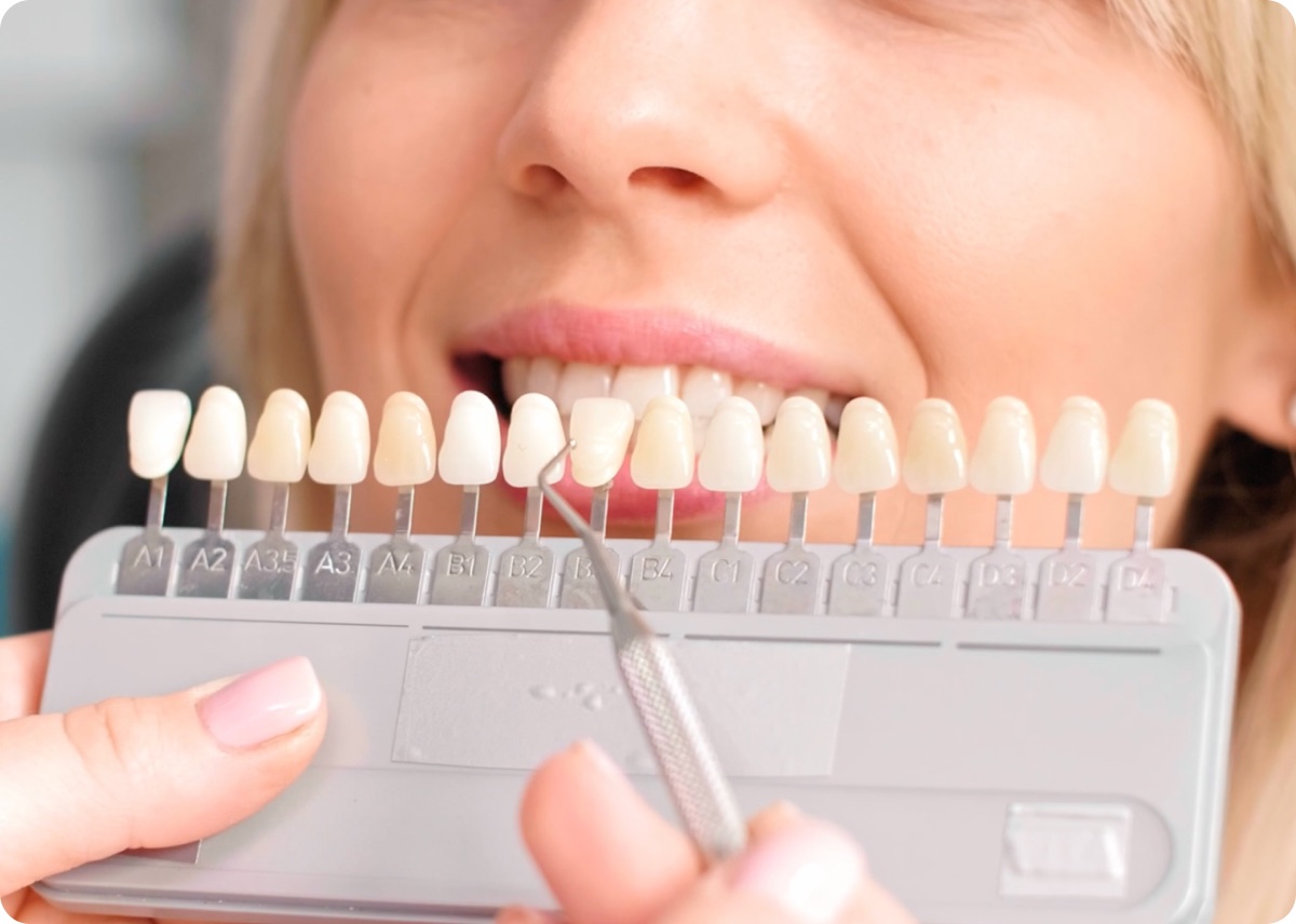 Dentist comparing tooth shades with a whitening shade guide