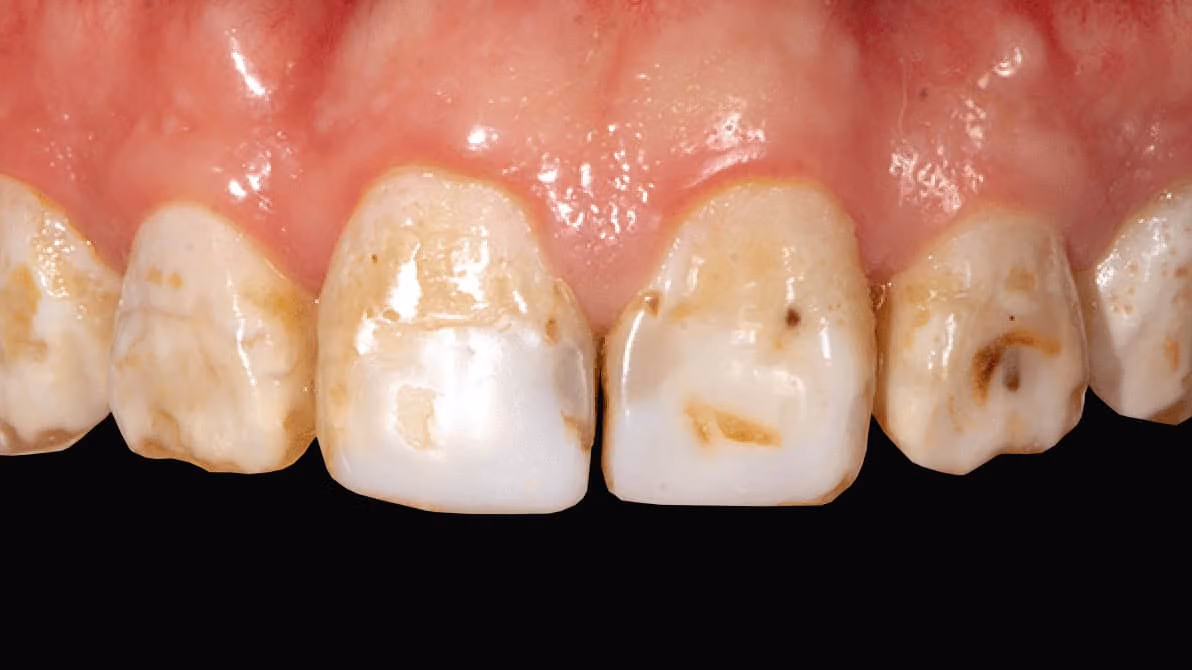 A severe case of fluorosis