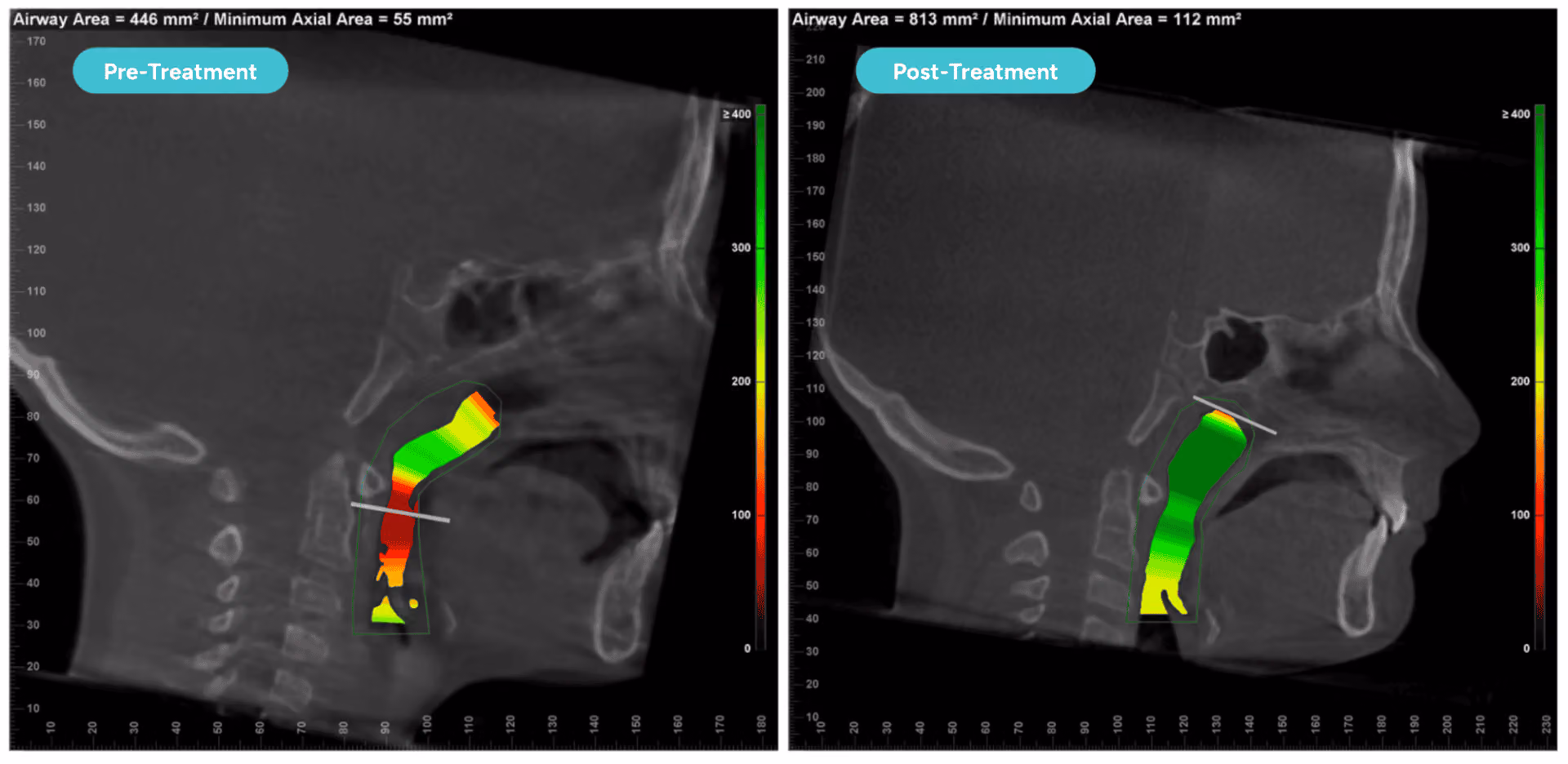 Pre- and post-CBCT of a patient treated by The Airway Dentists