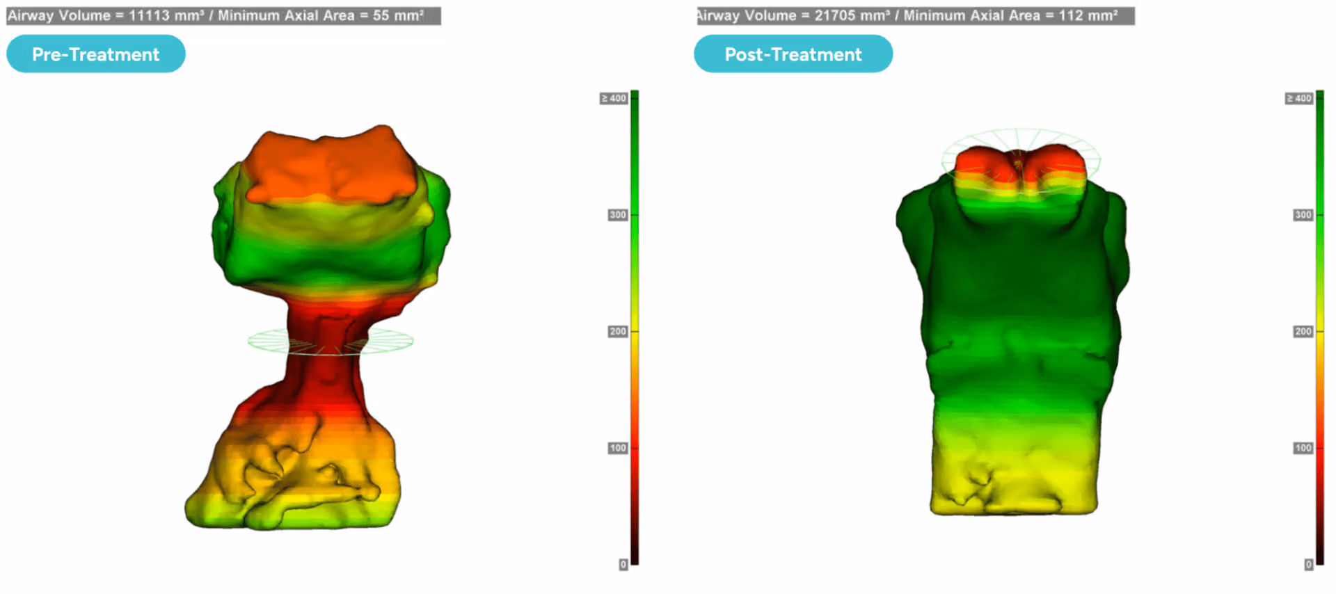 Pre- and post-volumetric airway scans