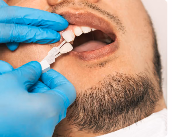 Dentist matching a veneer shade guide to a patient's tooth.