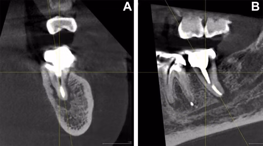 CBCT scan with coronal and sagittal views of a tooth and surrounding bone.