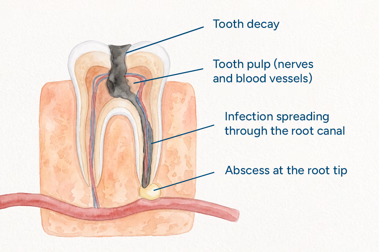 Illustration showing tooth decay reaching the pulp and infection near the root tip.