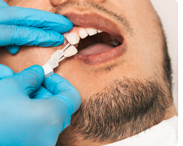 Dentist matching a veneer shade guide to a patient's tooth.
