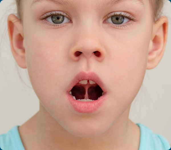 Close-up of a young child breathing through an open mouth, illustrating oral function and airway development.