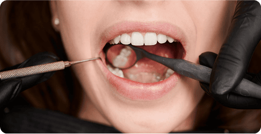 Mercury-Free Fillings in Houston, TX