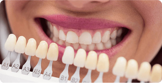 Teeth Whitening in Houston, TX