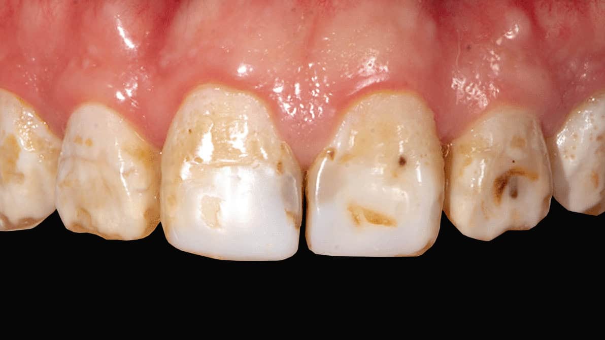 A severe case of fluorosis