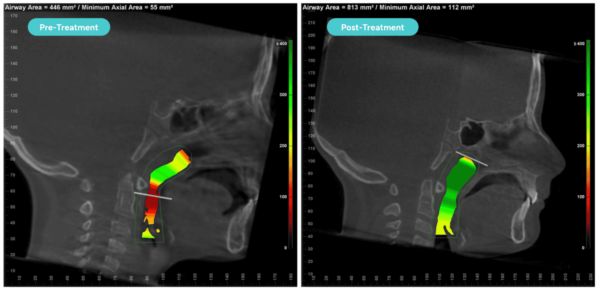 Is It ADHD or Sleep-Disordered Breathing? 2 Pre- and post-CBCT of a patient treated by The Airway Dentists