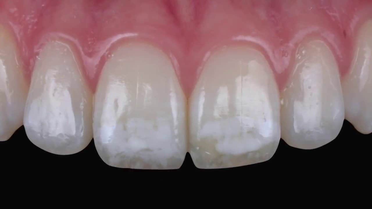 A moderate case of fluorosis