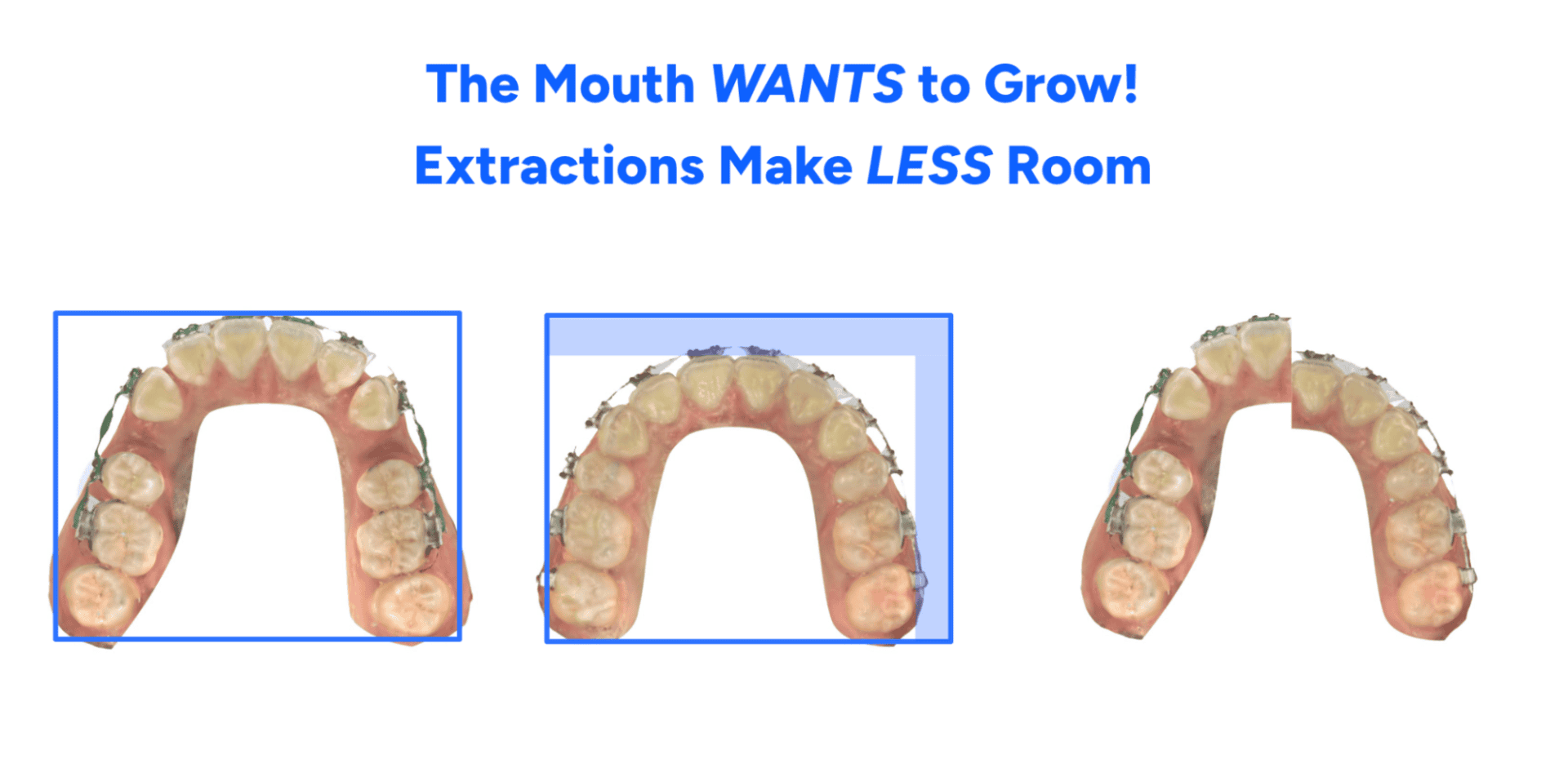 Before-and-after images show how the shape of the arch collapses inward when bicuspids are removed