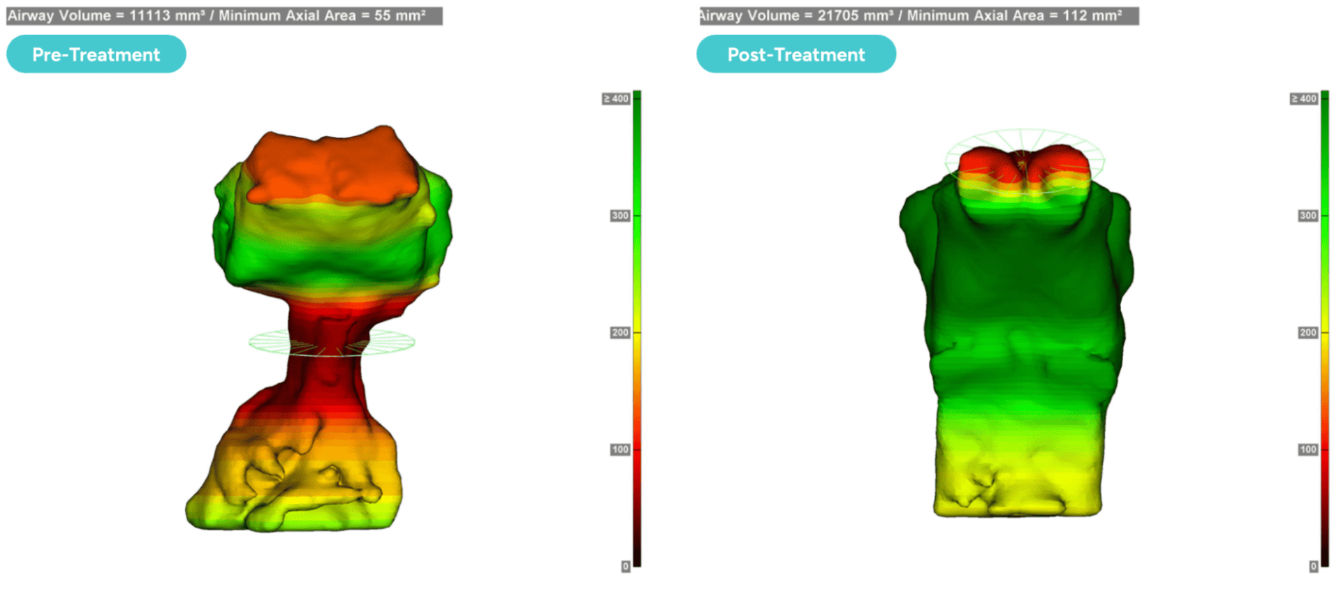 Is It ADHD or Sleep-Disordered Breathing? 3 Pre- and post-volumetric airway scans