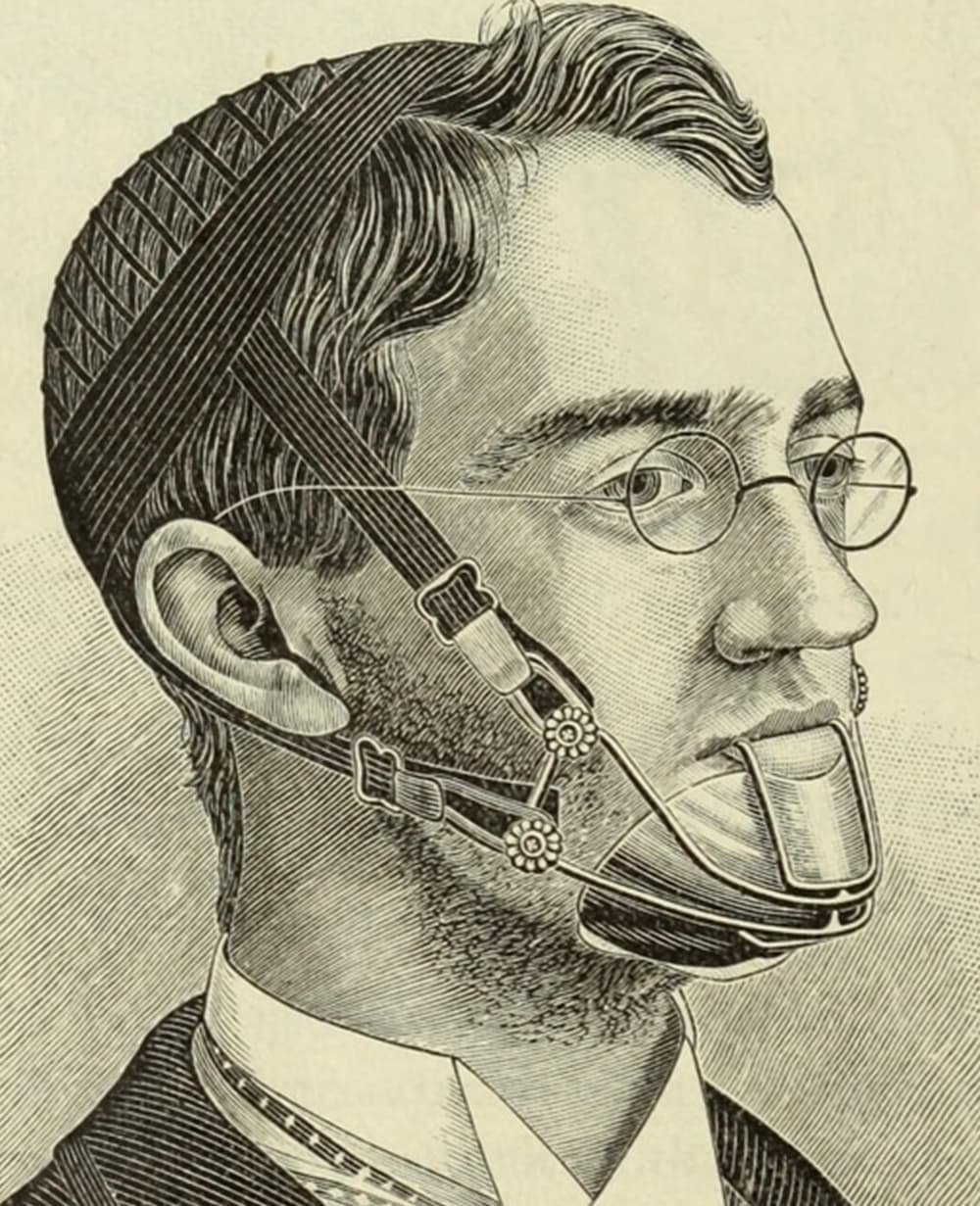 Illustration from the 1800s of a braces and headgear device