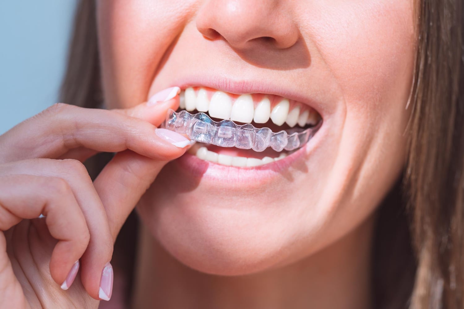 A woman placing a clear orthodontic retainer over her upper teeth, showing a close-up of her smile and fingers holding the aligner.