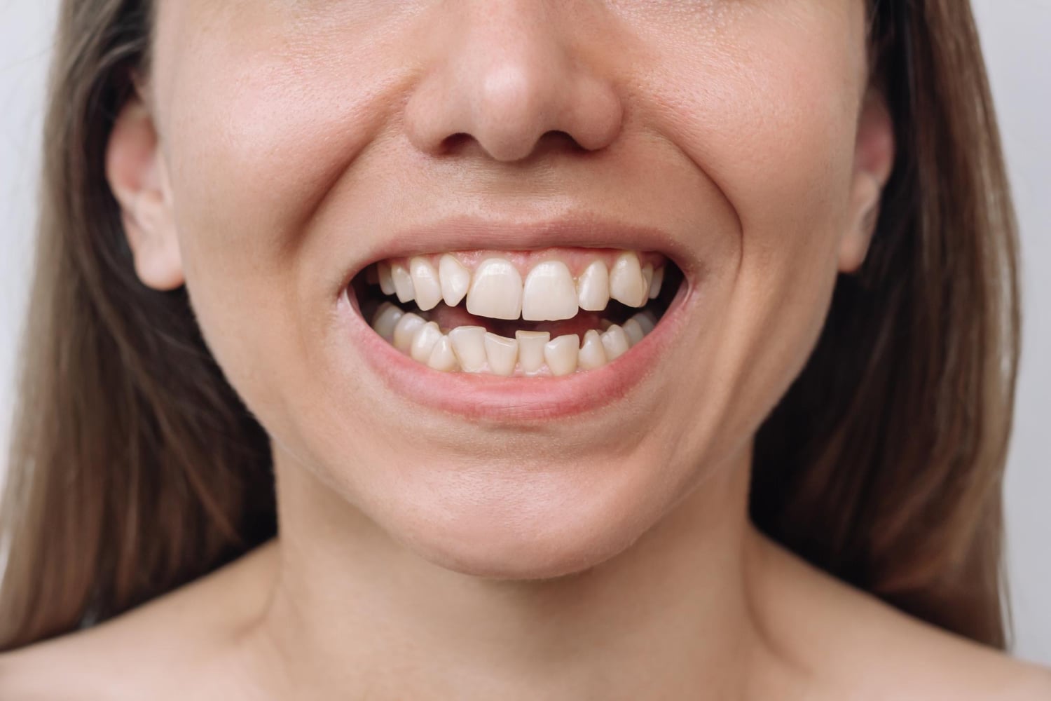 Close-up of a woman smiling, showing misaligned and crowded upper and lower front teeth.