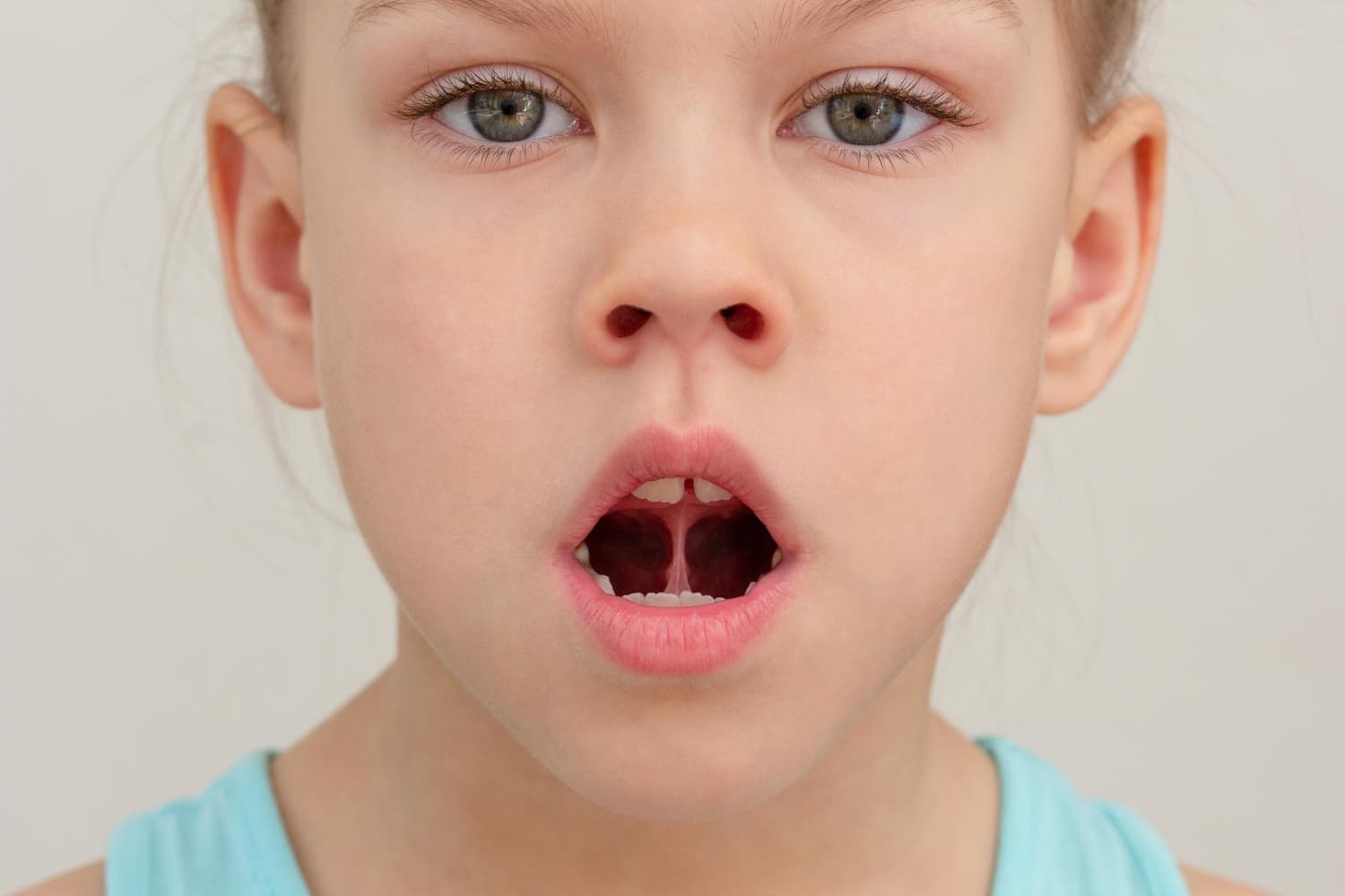 A child with a cleft palate has an opening in the roof of the mouth, visible inside their open mouth.